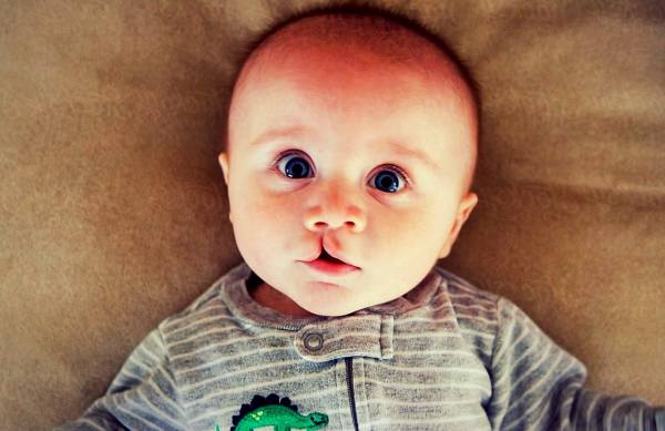 شیشه شیر شکاف کام